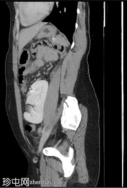 单输尿管交叉融合异位肾