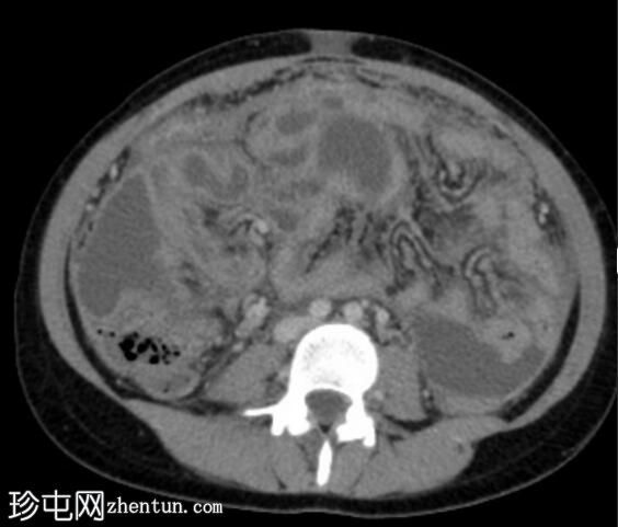 结核性腹膜炎