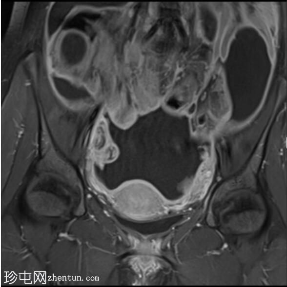 结核性腹膜炎