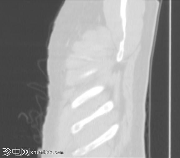 肺梗塞伴残腔和纤维化