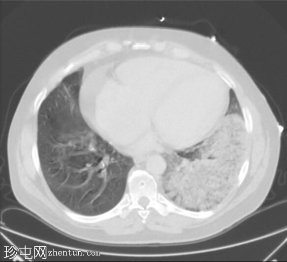 肺梗塞伴残腔和纤维化