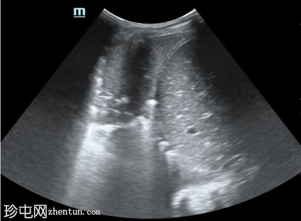超声检查显示右肺肺炎