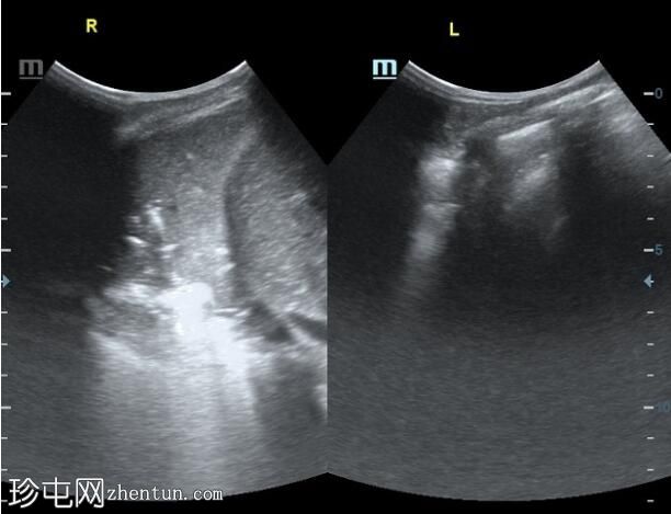 超声检查显示右肺肺炎