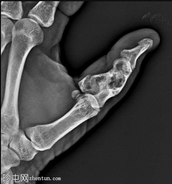 指骨病理性骨折——内生软骨瘤