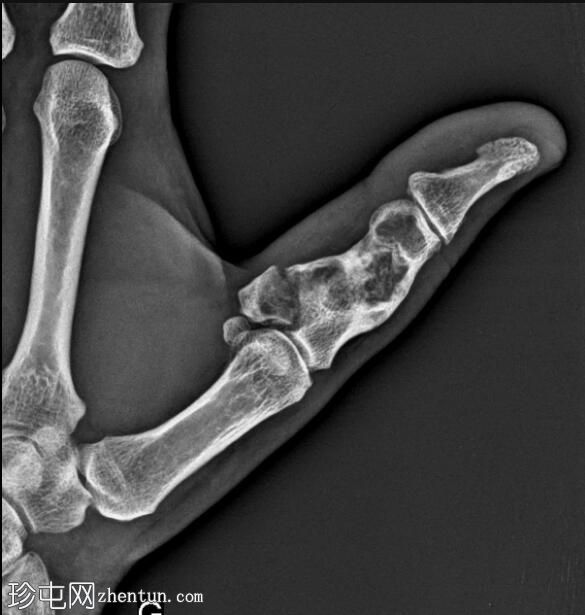 指骨病理性骨折——内生软骨瘤