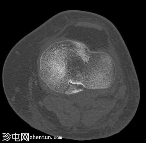 后交叉韧带撕脱性骨折