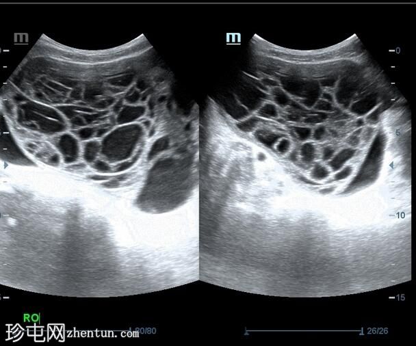 卵巢囊腺瘤