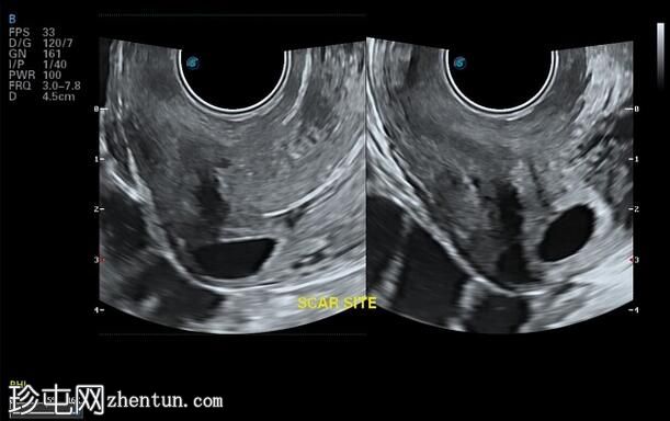 剖宫产疤痕双胞胎异位妊娠