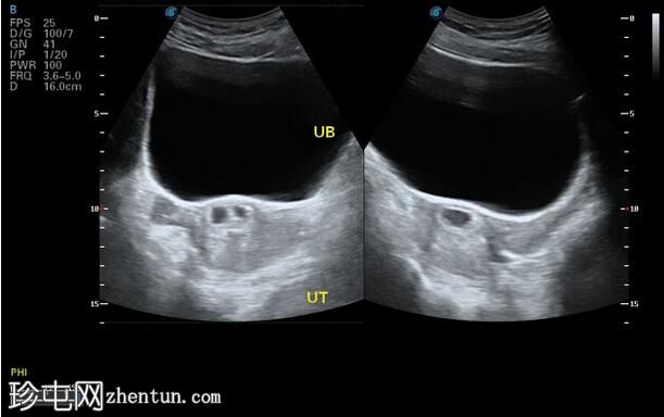 剖宫产疤痕双胞胎异位妊娠