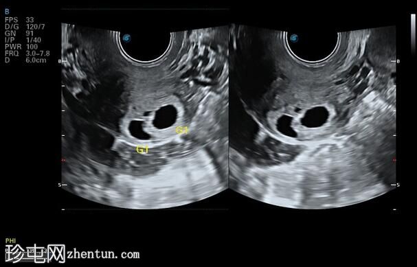 剖宫产疤痕双胞胎异位妊娠