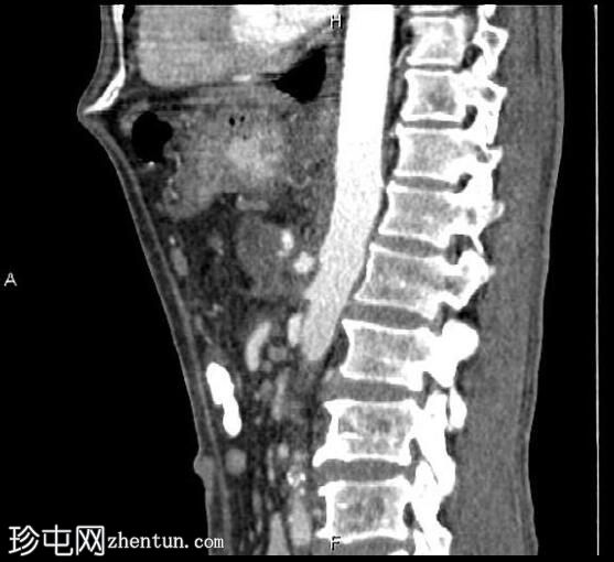 胰腺导管腺癌 - 不可切除