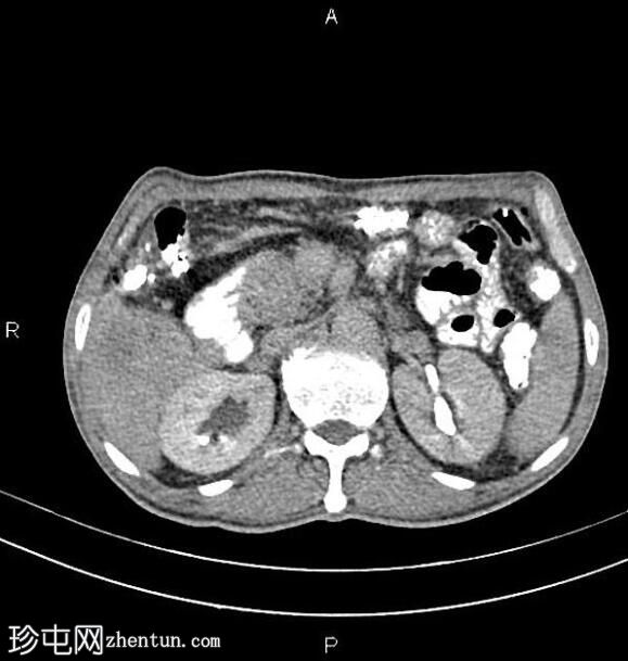 胰腺导管腺癌 - 不可切除