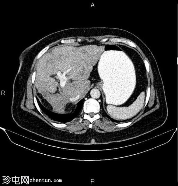 乳腺癌转移化疗引起的假性肝硬化