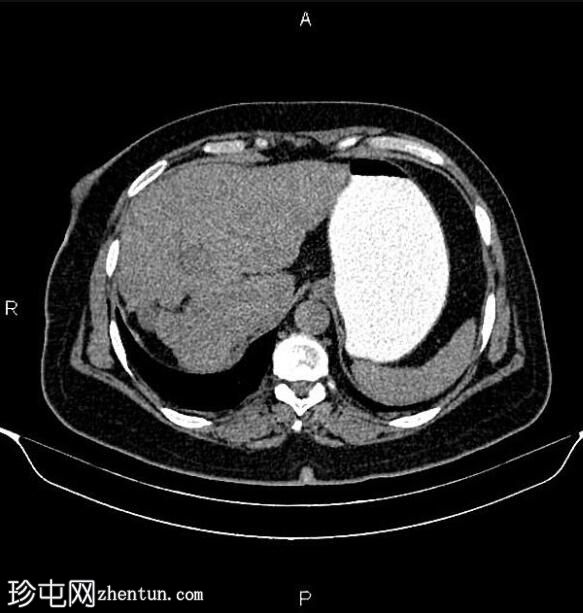 乳腺癌转移化疗引起的假性肝硬化