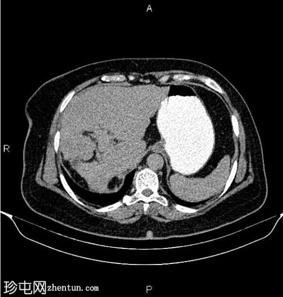 乳腺癌转移化疗引起的假性肝硬化