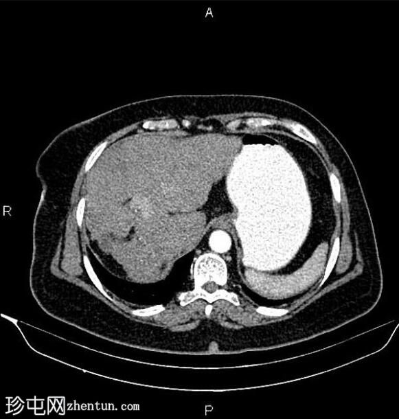 乳腺癌转移化疗引起的假性肝硬化