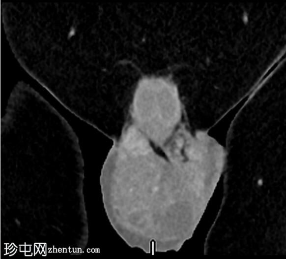 睾丸混合生殖细胞肿瘤