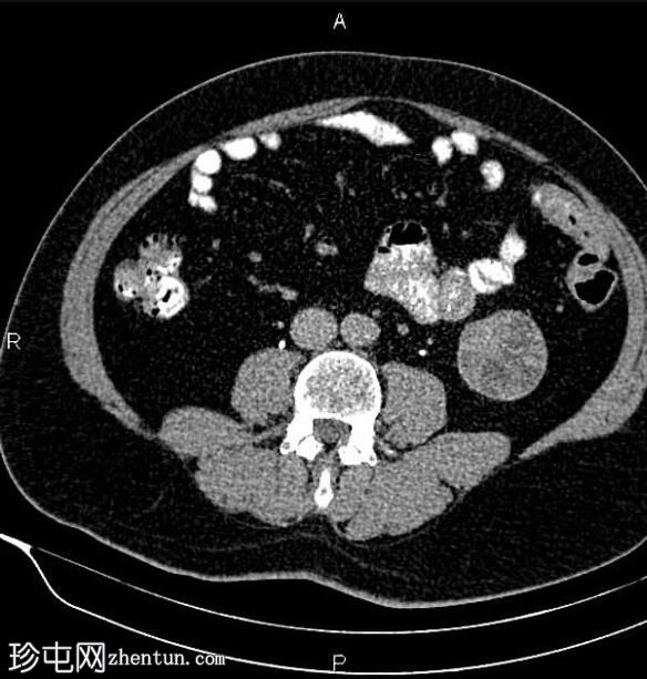 肾囊性肿块（Bosniak IV 级）