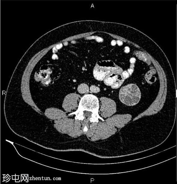 肾囊性肿块（Bosniak IV 级）