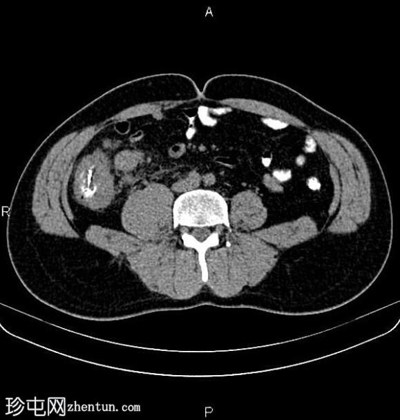 转移性升结肠腺癌