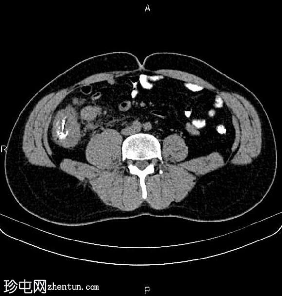 转移性升结肠腺癌