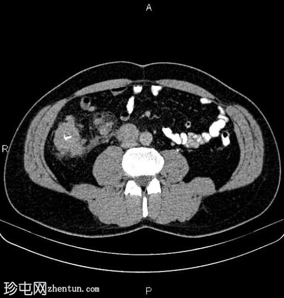 转移性升结肠腺癌