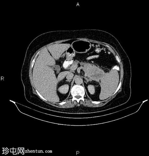 胰腺腺鳞癌