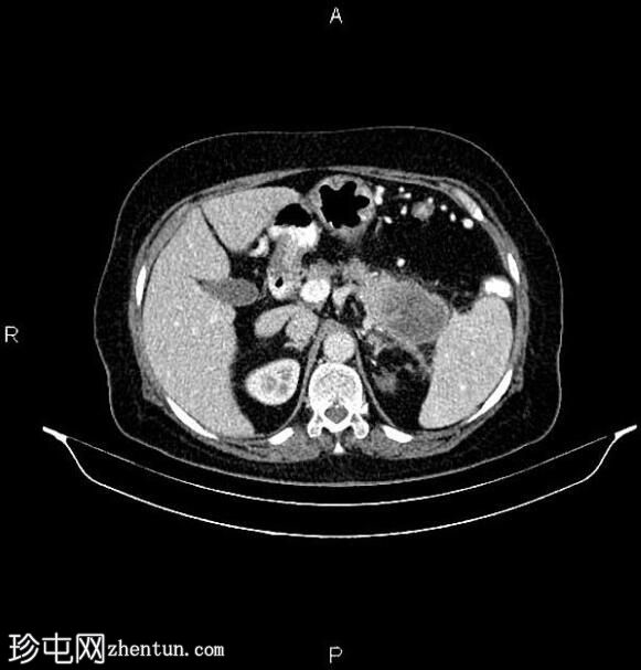 胰腺腺鳞癌