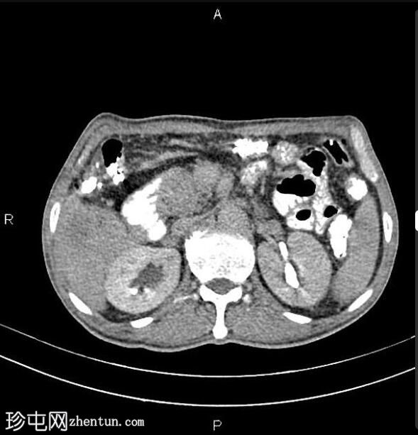 胰腺导管腺癌 - 不可切除