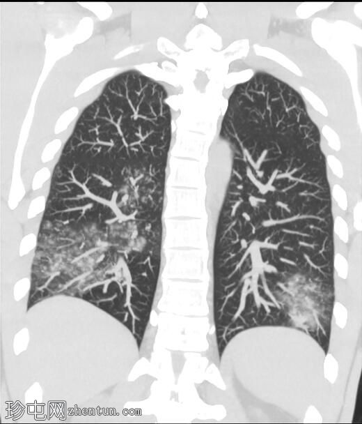 非典型肺炎-偏肺病毒