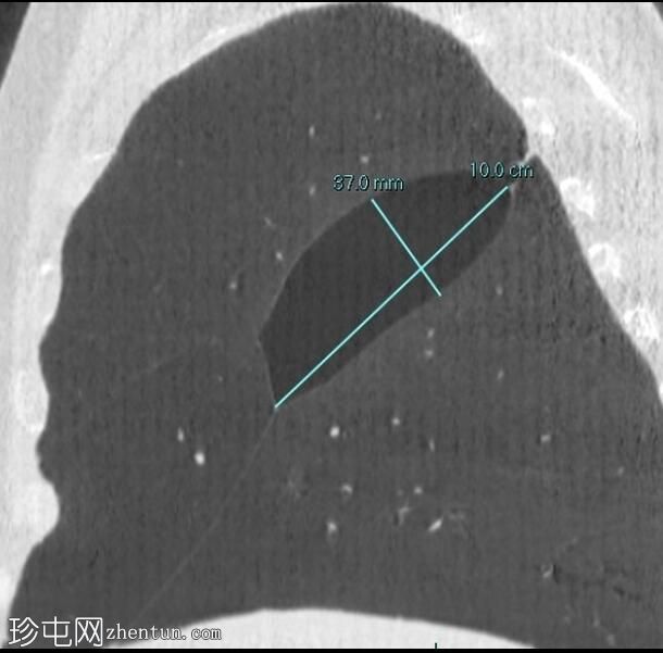 叶间局限性气胸