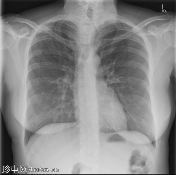 FNA 后因多结节性甲状腺肿导致气管严重狭窄