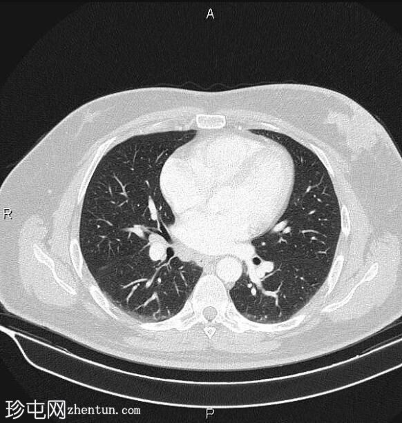 乳腺多灶性浸润性导管癌 - 男性