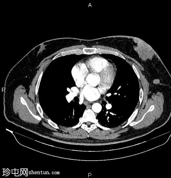 乳腺多灶性浸润性导管癌 - 男性
