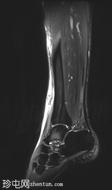 与跟舟联合相关的胫骨前肌腱断裂