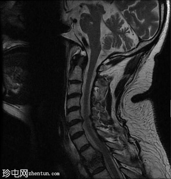 椎间盘炎伴硬膜外和椎旁脓肿