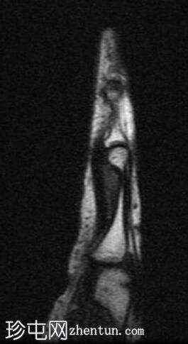 腱鞘巨细胞瘤 - 食指