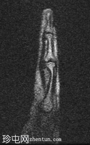 腱鞘巨细胞瘤 - 食指