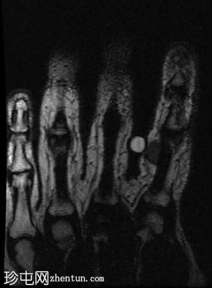 腱鞘巨细胞瘤 - 食指