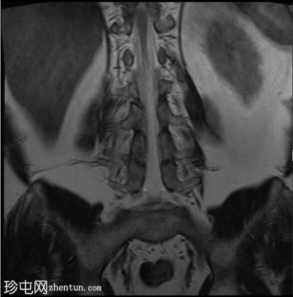 强直性脊柱炎