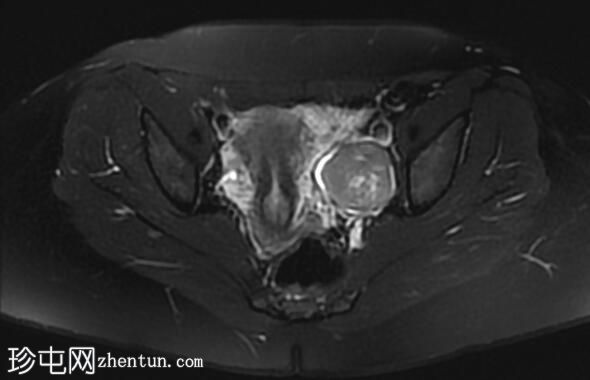 卵巢纤维瘤