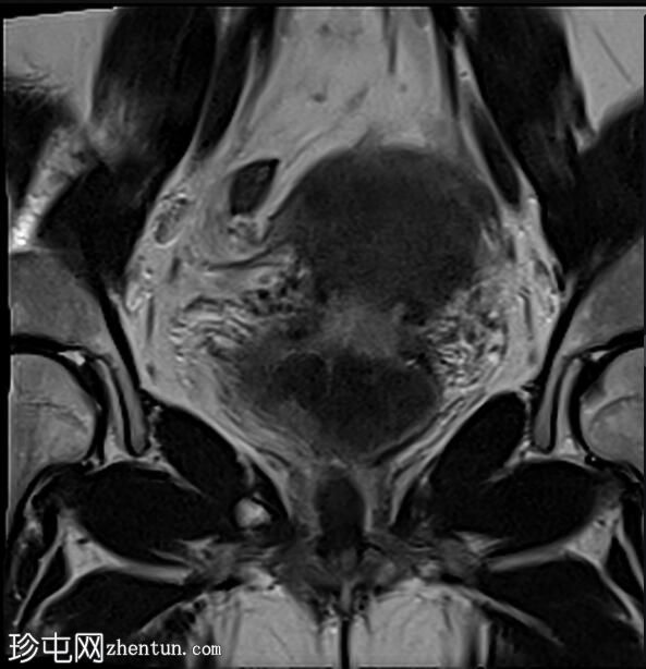 带蒂粘膜下子宫肌瘤伸入阴道