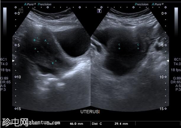 成熟囊性卵巢畸胎瘤