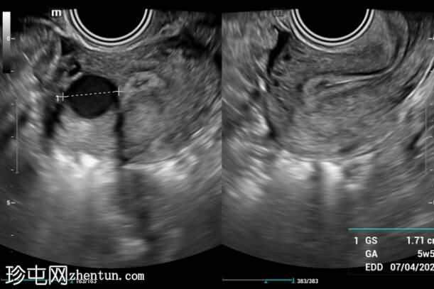 间质性宫外孕