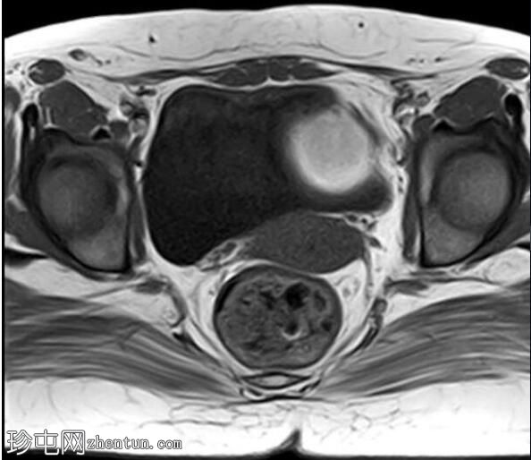 深部浸润的卵巢子宫内膜异位瘤