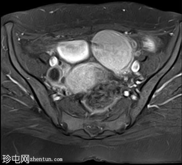 深部浸润的卵巢子宫内膜异位瘤