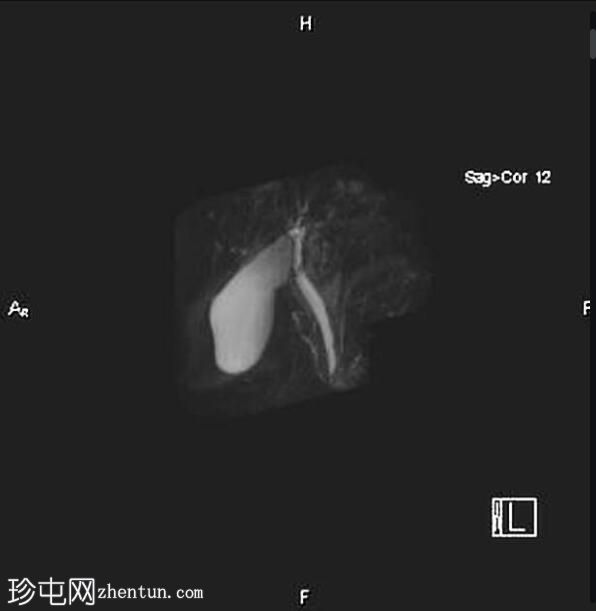 肝动脉搏动假象导致肝外胆管假性狭窄