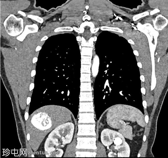 钙化肝包虫囊肿