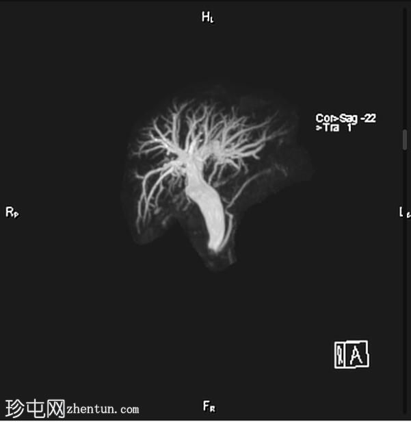 胆总管结石