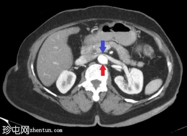 鱼尾胰（双歧胰）和主动脉环左肾静脉